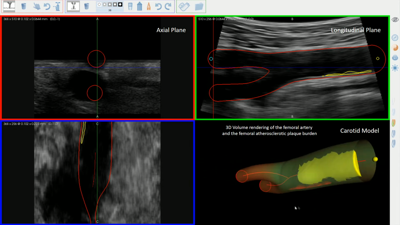 Ecografías vasculares en 2 e 3D para diagnosticar futuras enfermidades cardiovasculares